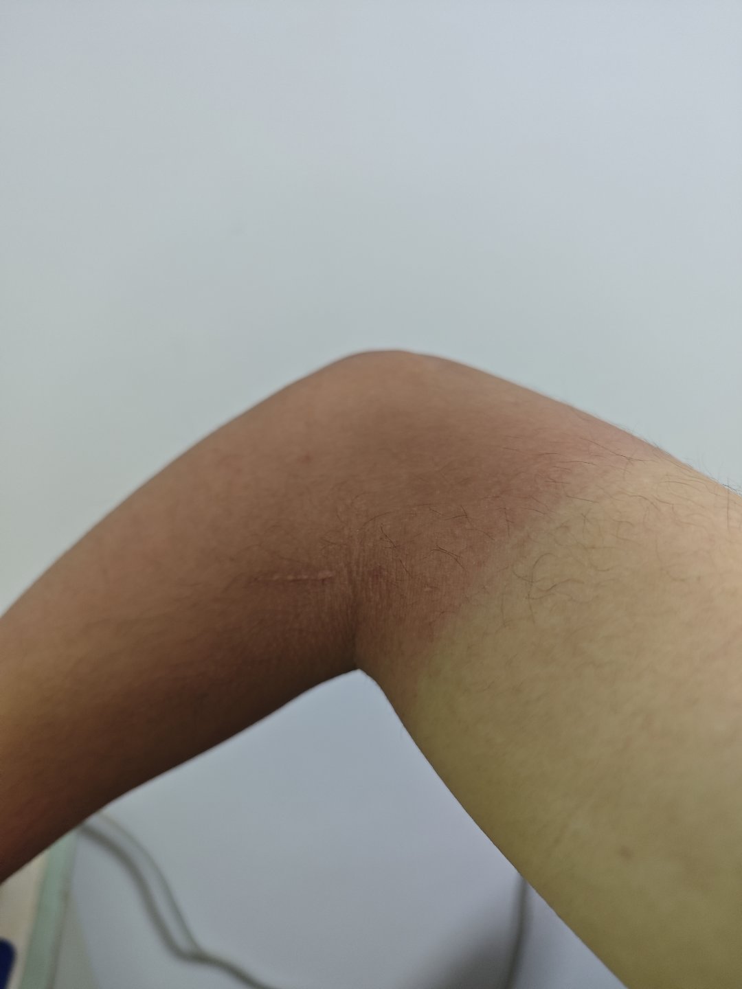 今天的爬山和晒伤，总结一下就是8