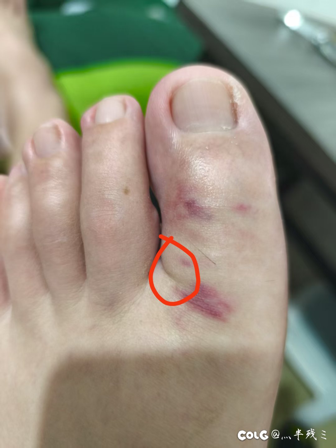 记录我的玉足几天养好1