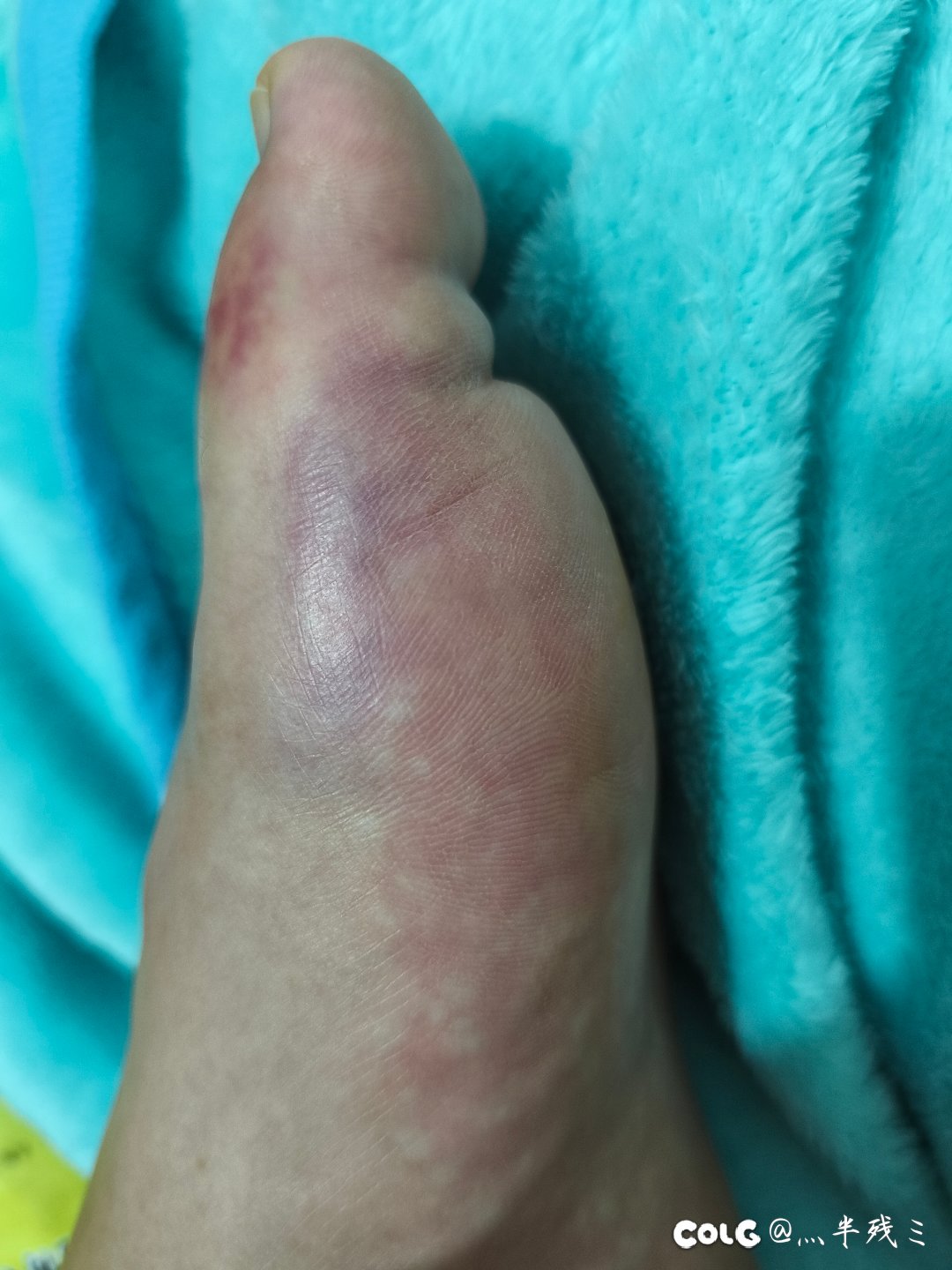 记录我的玉足几天养好5