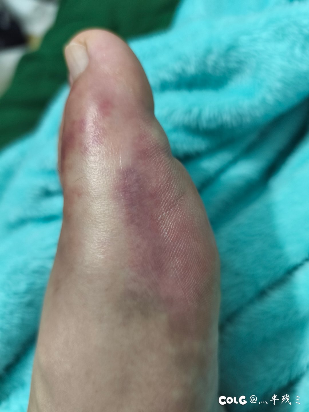 记录我的玉足几天养好7