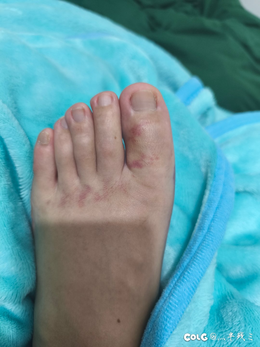 记录我的玉足几天养好10